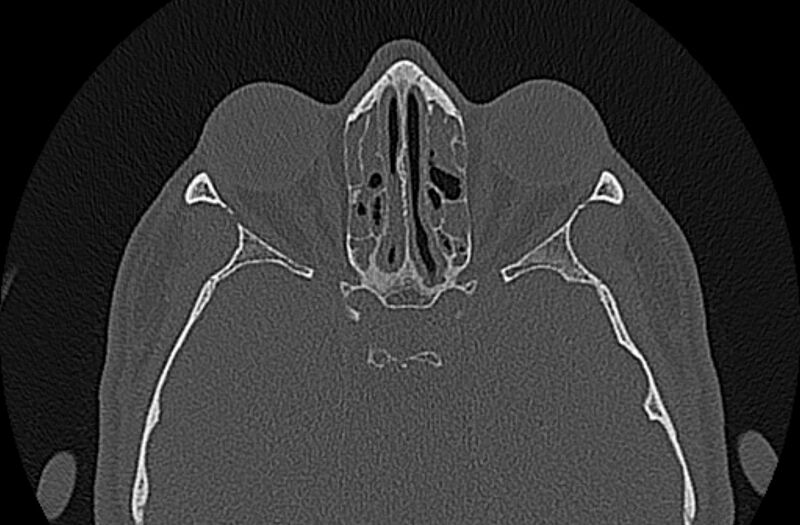 File:Chronic rhinosinusitis (Radiopaedia 65079-74075 Axial bone window 56).jpg