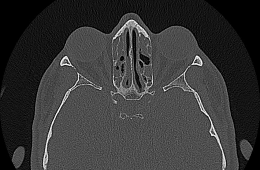Chronic rhinosinusitis (Radiopaedia 65079-74075 Axial bone window 56).jpg