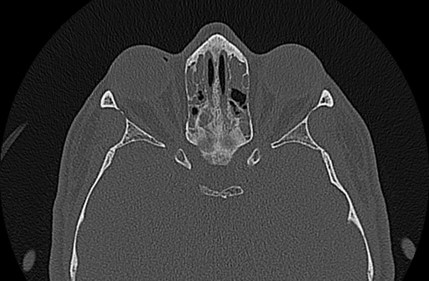 Chronic rhinosinusitis (Radiopaedia 65079-74075 Axial bone window 58).jpg
