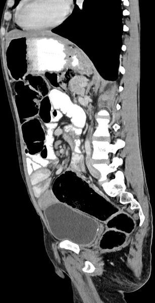 File:Chronic small bowel volvulus (Radiopaedia 75224-86322 C 63).jpg