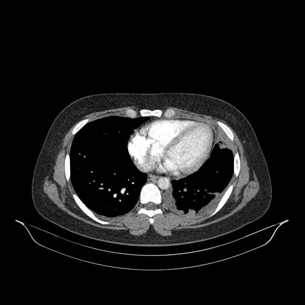 File:Chronic thromboembolic pulmonary hypertension (CTEPH) (Radiopaedia 74597-85532 Axial C+ CTPA 58).jpg