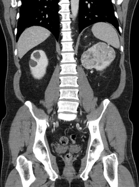 File:Clear cell renal cell carcinoma (Radiopaedia 61449-69393 F 34).jpg