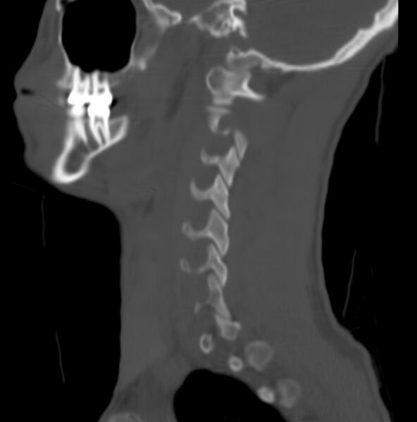 File:Cleft of the posterior arch of C1 mimicking fracture (Radiopaedia 40201-42721 Sagittal bone window 16).jpg