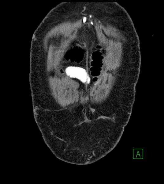 File:Closed-loop small bowel obstruction-internal hernia (Radiopaedia 78439-91096 Coronal non-contrast 17).jpg