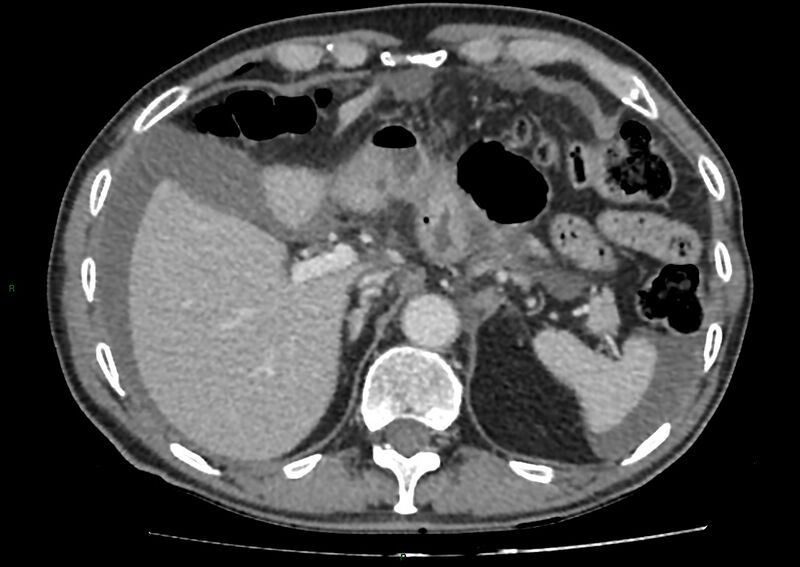 File:Closed loop small bowel obstruction with ischemia (Radiopaedia 84180-99456 A 25).jpg
