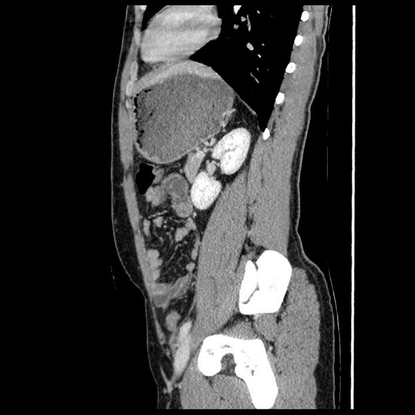 File:Co-existing acute appendicitis and epiploic appendagitis (Radiopaedia 61789-69911 B 66).jpg