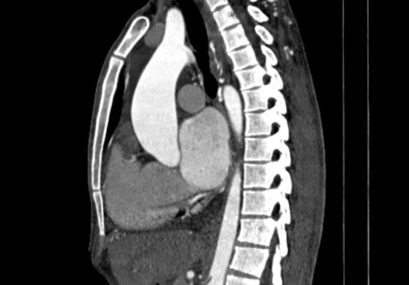 File:Coarctation of aorta with aortic valve stenosis (Radiopaedia 70463-80574 B 60).jpg