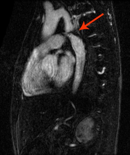 File:Coarctation of the aorta (Radiopaedia 11320-39270 None 1).jpg