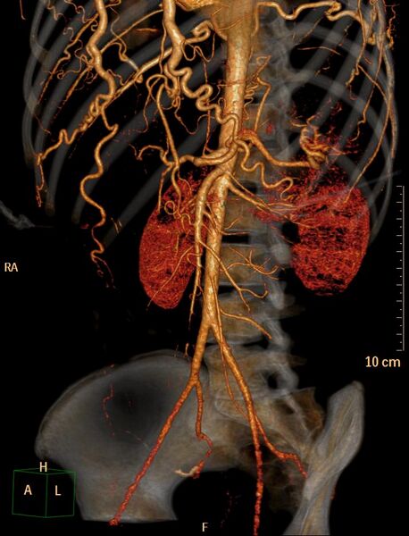 File:Coarctation of the aorta (Radiopaedia 27458-27657 3D 13).jpg