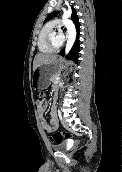 File:Coarctation of the aorta (Radiopaedia 49784-55050 C 66).jpg