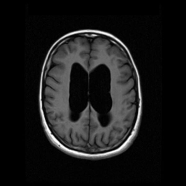 File:Colloid cyst with hydrocephalus (Radiopaedia 9373-10065 Axial T1 13).jpg