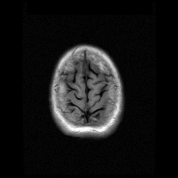 File:Colloid cyst with hydrocephalus (Radiopaedia 9373-10065 Axial T1 18).jpg
