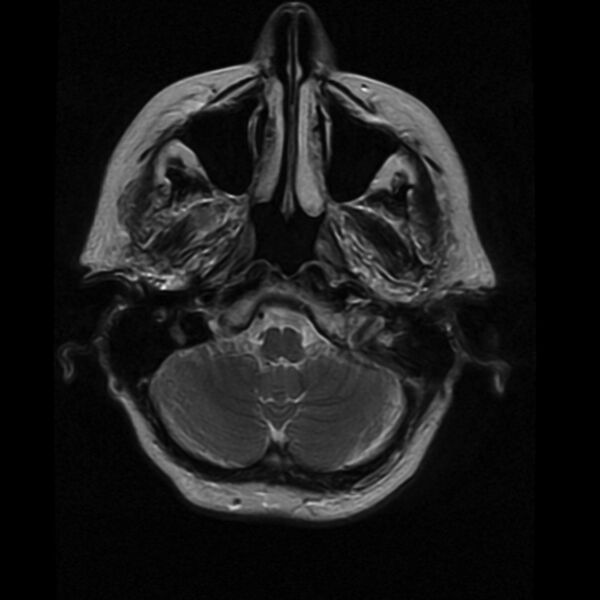 File:Colloid cyst with hydrocephalus (Radiopaedia 9373-10065 Axial T2 3).jpg