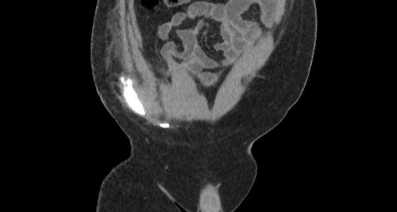 File:Colocutaneous fistula (Radiopaedia 56401-63062 C 15).jpg