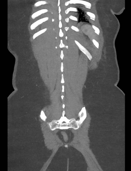 File:Colonic pseudo-obstruction (Radiopaedia 79752-92980 B 51).png