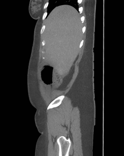 File:Colonic pseudo-obstruction (Radiopaedia 79752-92980 C 15).png
