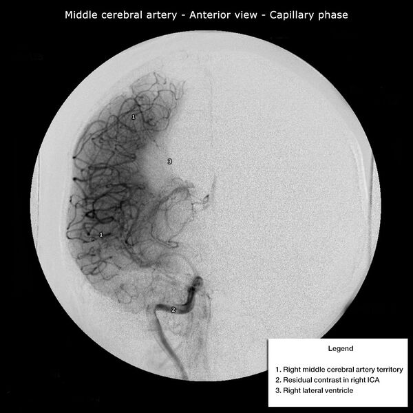 File:Middle cerebral artery territory on angiography (Radiopaedia 36102).jpg