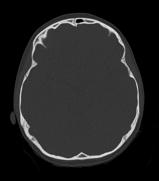 File:Nasoorbitoethmoid fracture (Radiopaedia 90044-107205 Axial bone window 96).jpg