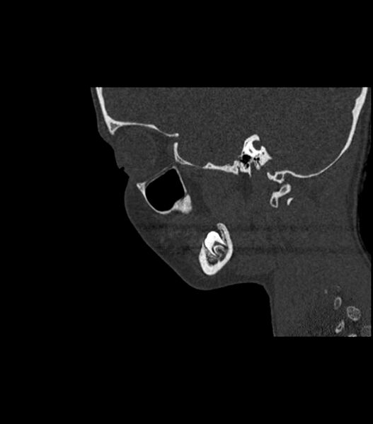 File:Nasoorbitoethmoid fracture (Radiopaedia 90044-107205 Sagittal bone window 46).jpg