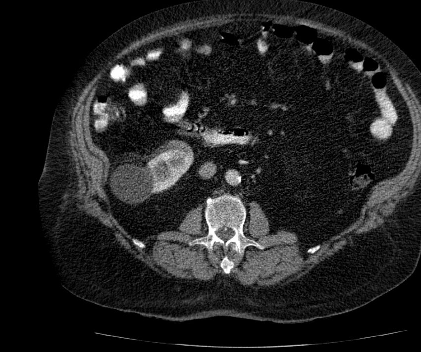 Nephroptosis with inguinal hernia containing perirenal fat (Radiopaedia 56632-63391 C 165).jpg