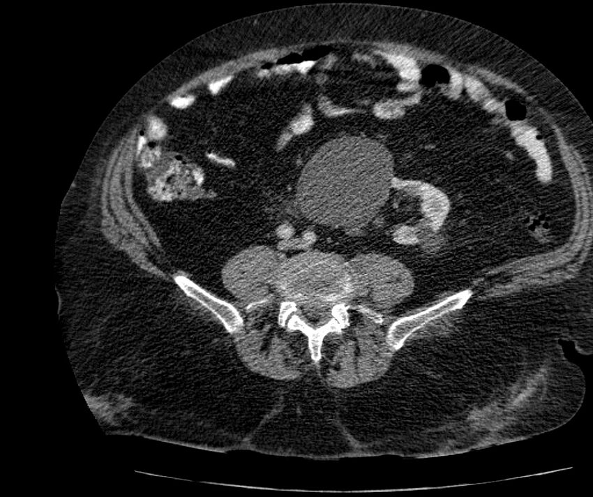 Nephroptosis with inguinal hernia containing perirenal fat (Radiopaedia 56632-63391 C 223).jpg