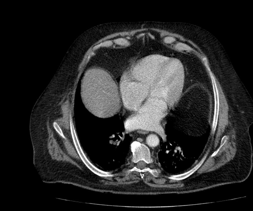 Nephroptosis with inguinal hernia containing perirenal fat (Radiopaedia 56632-63391 C 33).jpg