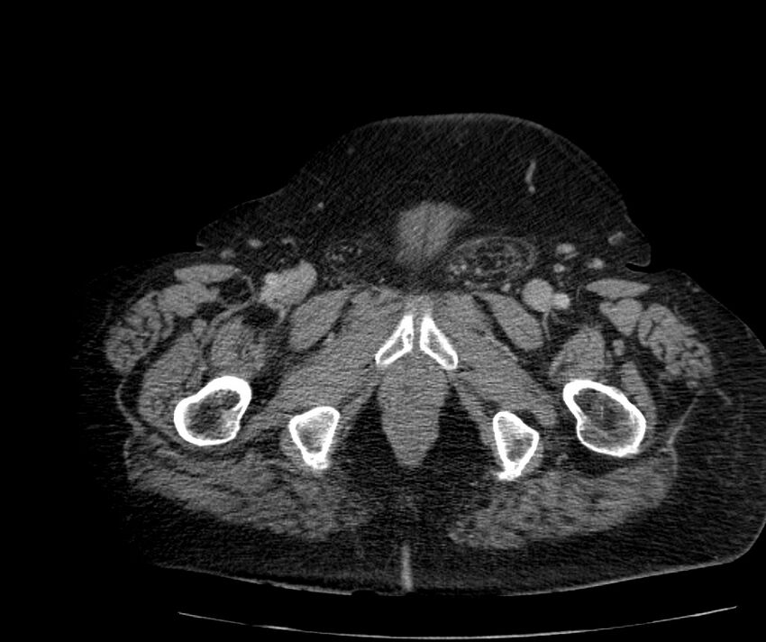 Nephroptosis with inguinal hernia containing perirenal fat (Radiopaedia 56632-63391 C 338).jpg