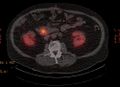 Neuroendocrine tumor- pancreas (Radiopaedia 11670-32204 PET-CT 1).jpg