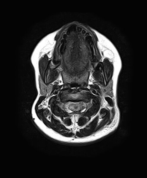 File:Neurofibromatosis type 2 (Radiopaedia 66211-75401 Axial FLAIR 4).jpg