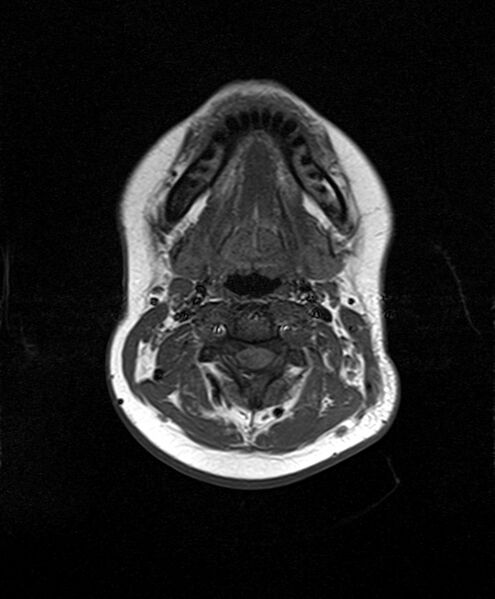 File:Neurofibromatosis type 2 (Radiopaedia 66211-75401 Axial T1 1).jpg