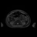 Normal MRI abdomen in pregnancy (Radiopaedia 88001-104541 D 26).jpg