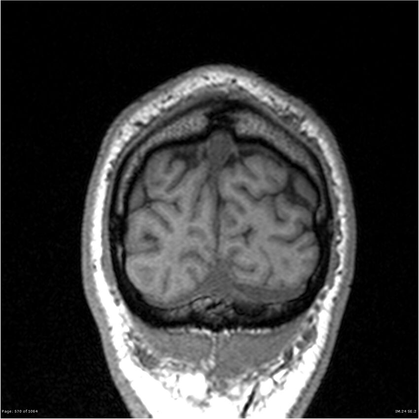 Normal brain MRI (non-focal epilepsy protocol) (Radiopaedia 38571-40700 Coronal T1 11).jpg