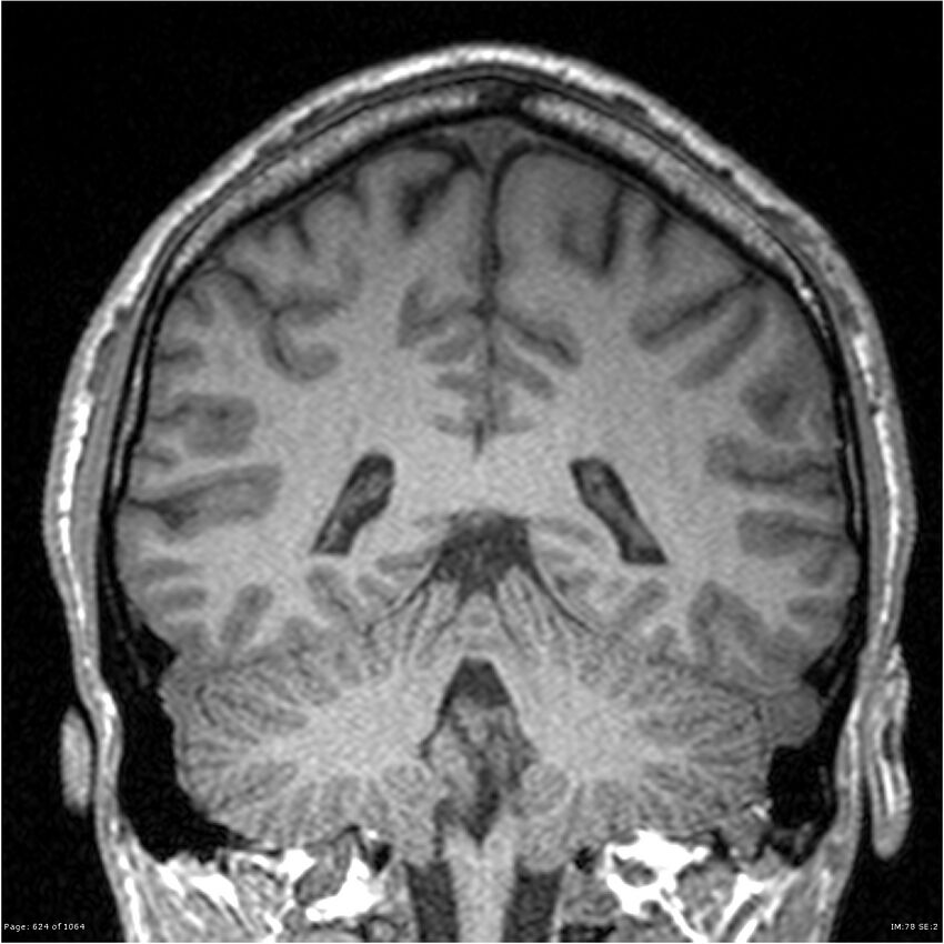 Normal brain MRI (non-focal epilepsy protocol) (Radiopaedia 38571-40700 Coronal T1 38).jpg