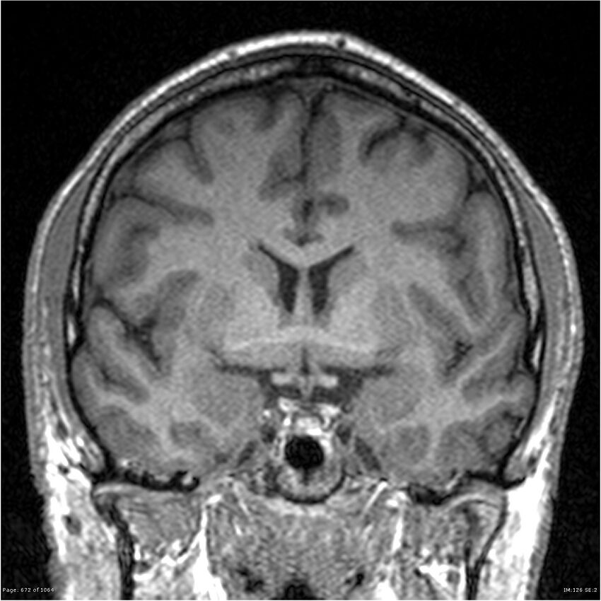 Normal brain MRI (non-focal epilepsy protocol) (Radiopaedia 38571-40700 Coronal T1 62).jpg