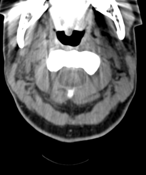 File:Normal cervical spine MRI (including Dixon) (Radiopaedia 42762-45926 Axial non-contrast 15).png