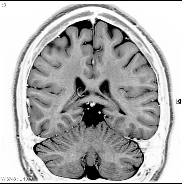 File:Normal coronal brain (Radiopaedia 6676-7910 B 30).jpg