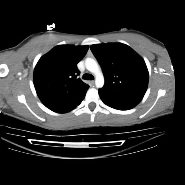 File:Normal dual-phase trauma CT chest,abdomen and pelvis (Radiopaedia 48092-52899 A 18).jpg