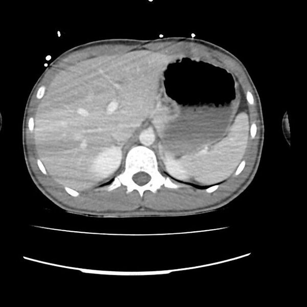 File:Normal dual-phase trauma CT chest,abdomen and pelvis (Radiopaedia 48092-52899 A 54).jpg