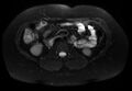 Normal liver MRI with Gadolinium (Radiopaedia 58913-66163 Axial T2 fat sat 13).jpg