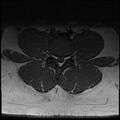 Normal lumbar spine MRI (Radiopaedia 47857-52609 Axial T1 17).jpg