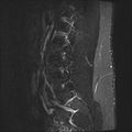 Normal lumbar spine MRI (Radiopaedia 47857-52609 Sagittal STIR 17).jpg