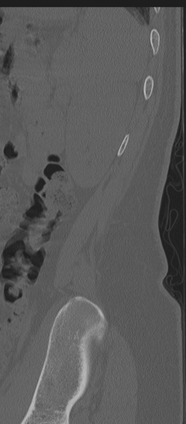 File:Normal lumbosacral CT (Radiopaedia 37923-39867 Sagittal bone window 5).png