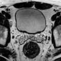 Normal prostate (MRI) (Radiopaedia 29986-30535 Axial T2 21).jpg