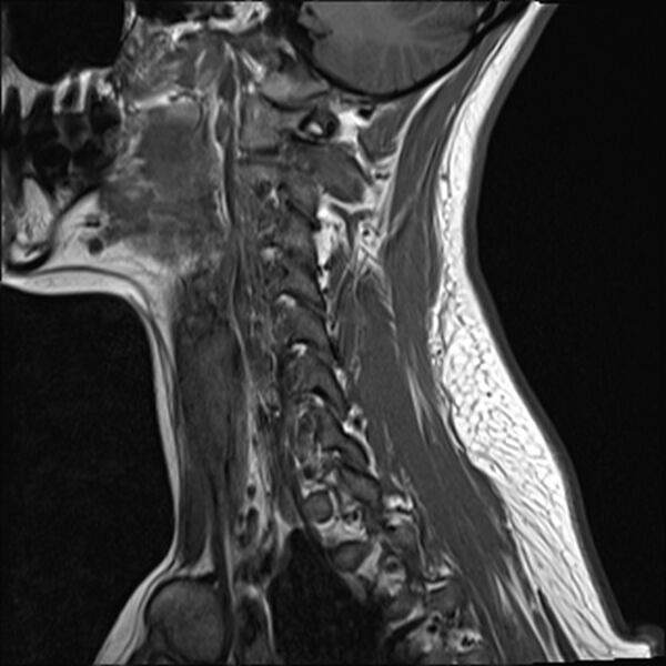 File:Normal trauma cervical spine MRI (Radiopaedia 32130-33071 Sagittal T1 14).jpg