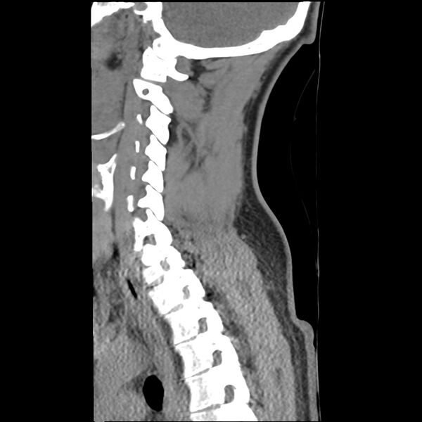 File:Normal trauma spine imaging (Radiopaedia 31753-32686 A 29).jpg