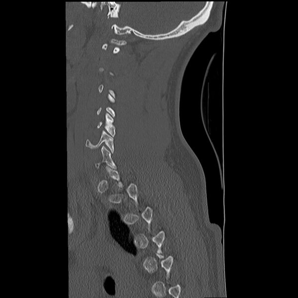 File:Normal trauma spine imaging (Radiopaedia 31753-32686 Sagittal bone window 33).jpg