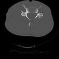 Normal trauma spine imaging (age 16) (Radiopaedia 45335-49358 Axial bone window 51).jpg