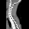 Normal trauma spine imaging (age 16) (Radiopaedia 45335-49358 C 14).jpg