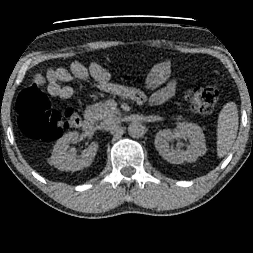 Obstructing ureteric calculus and ureteric anatomy (Radiopaedia 62730-71042 Axial non-contrast 29).jpg