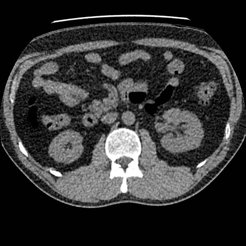 Obstructing ureteric calculus and ureteric anatomy (Radiopaedia 62730-71042 Axial non-contrast 43).jpg
